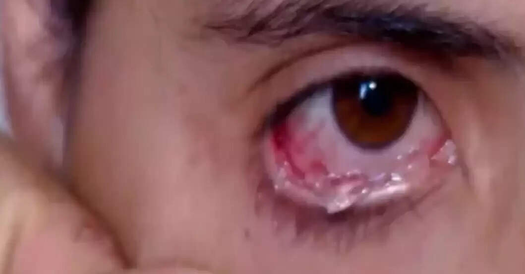 OMG: આંખોમાંથી આંસૂને બદલે ‘ક્રિસ્ટલ’ નીકળે છે એક મહિલાને
