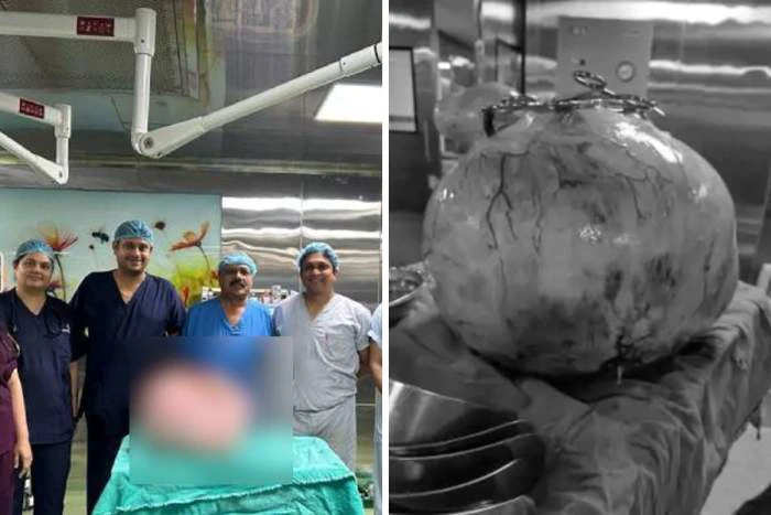 રીપોર્ટ@ઈન્દોર: એક મહિલાના પેટમાંથી ડોકટરોએ 15.2 કિલોની ગાંઠ કાઢતા,મહિલાને મળ્યું નવું જીવન 